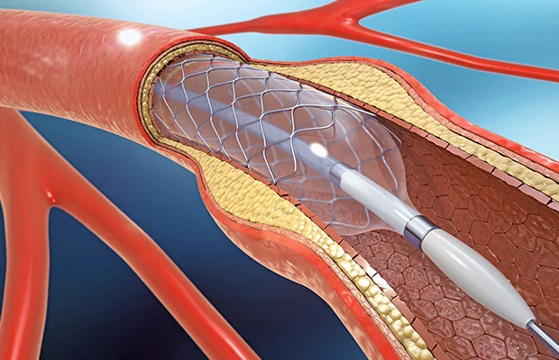Angioplasty/Stenting