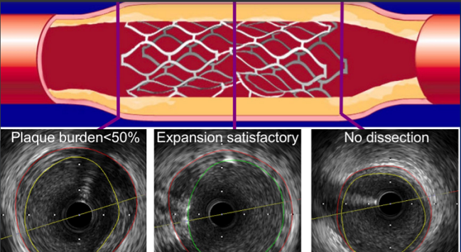 IVUS, OCT & FFR