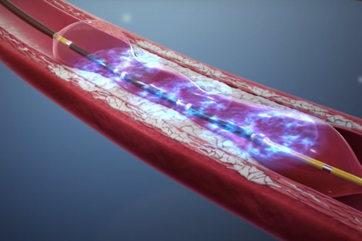 Intravascular Lithotripsy