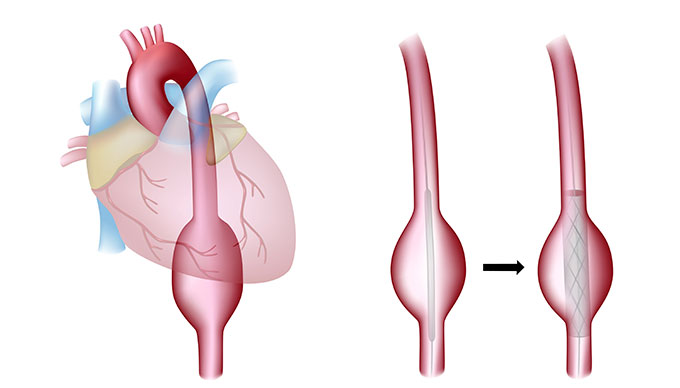 Endovascular Repair (EVAR)