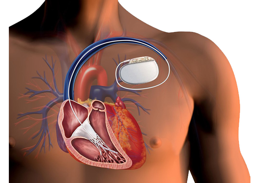 Pacemaker / AICD Implantation